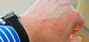 Dermatita de contact