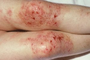 Dermatitele și eczemele