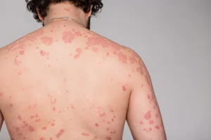 Psoriazisul